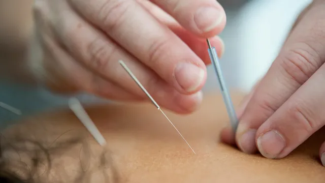 Praticien insérant une aiguille d'acupuncture dans la peau, gros plan sur les mains
