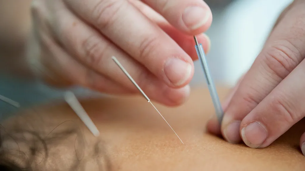 Praticien insérant une aiguille d'acupuncture dans la peau, gros plan sur les mains